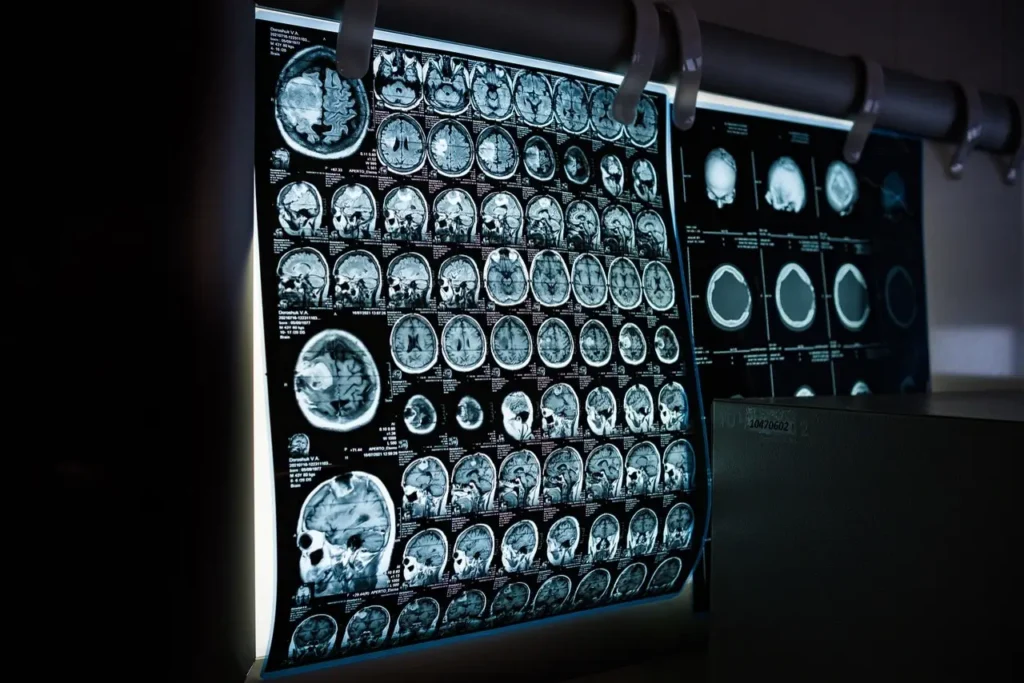 Resonancias cerebrales utilizadas para estudiar la actividad y estructura del cerebro humano